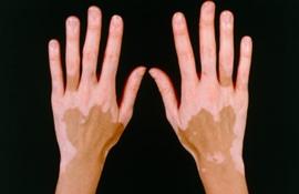 1342940409_vitiligo